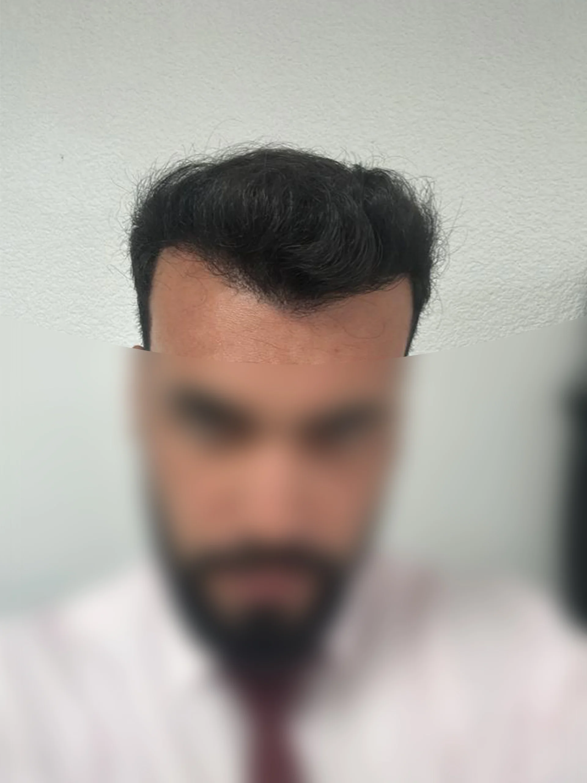4500 Grafts