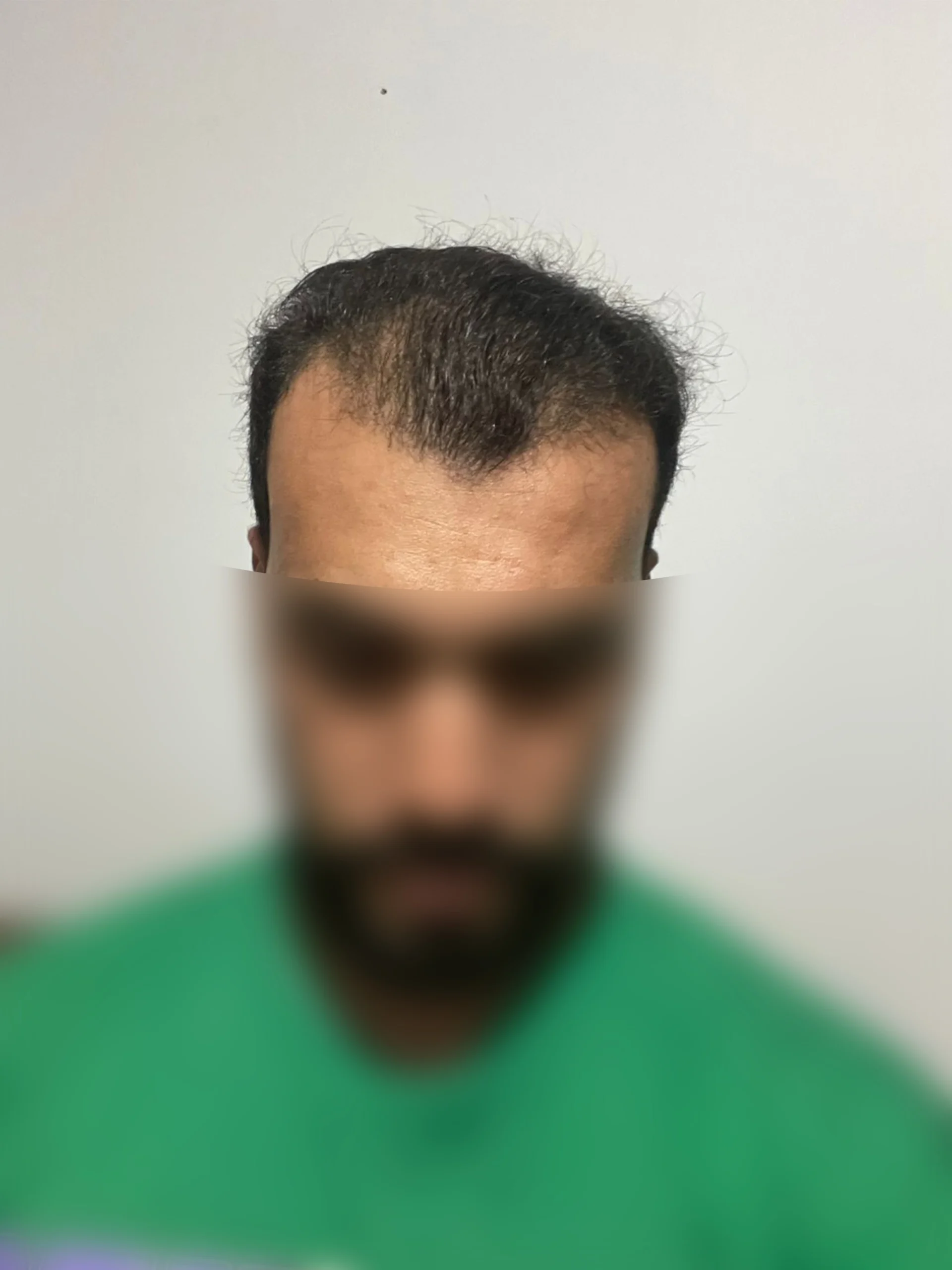 4500 Grafts